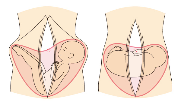 胎内姿勢 離開すると