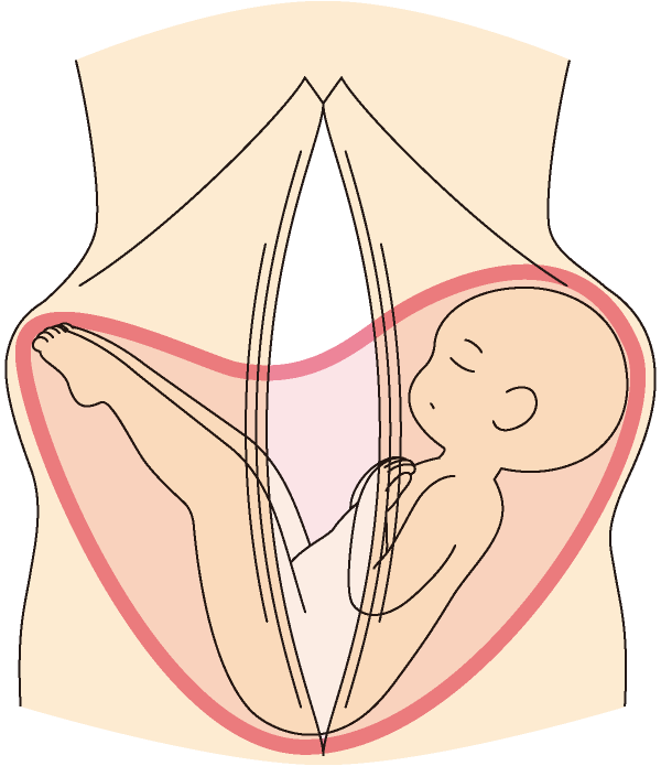 妊娠中～産後の腹直筋離開 | 骨盤ケア（トコちゃんベルトの青葉 公式サイト）